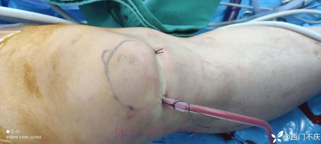 官方：阿拉巴成功接受了左膝内侧半月板撕裂手术